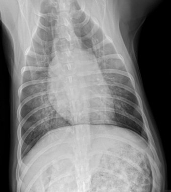 Bacterial Pneumonia